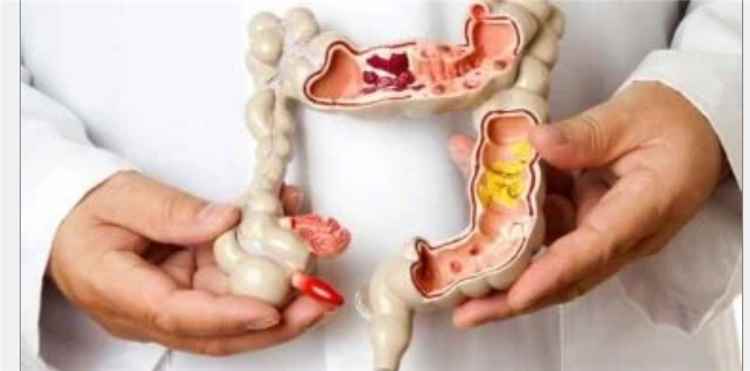 تناول اللحوم الحمراء يزيد من حدة أعراض هذا المرض المعوي