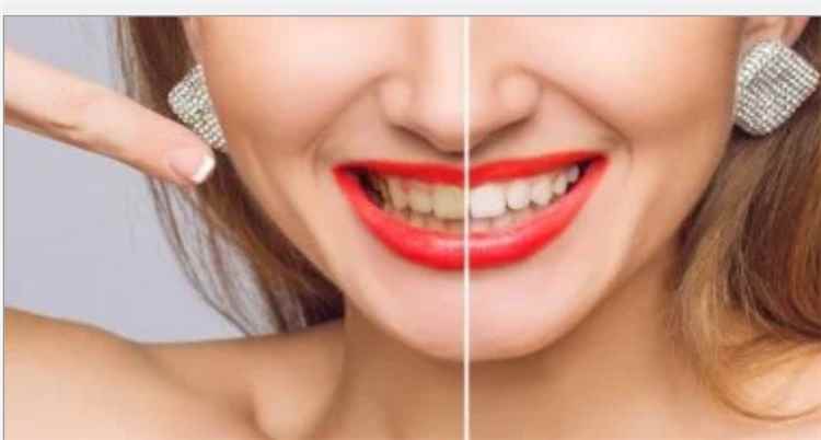 طرق طبيعية بسيطة للتخلص من اصفرار الأسنان