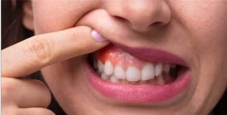 جفاف الفم فى الصباح وحالات صحية تسببه