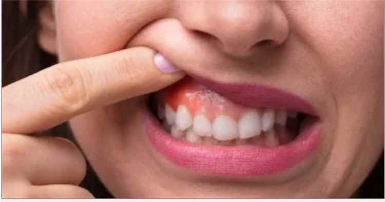 جفاف الفم في الصباح وحالات صحية تسببه